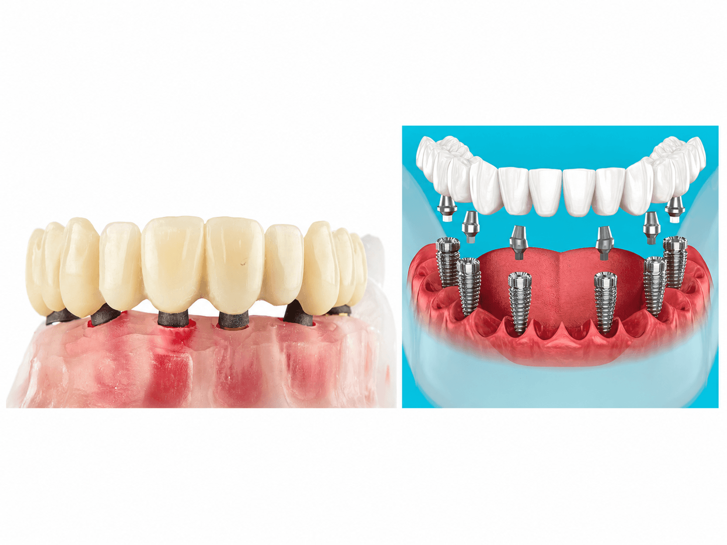 Dental implant restorations